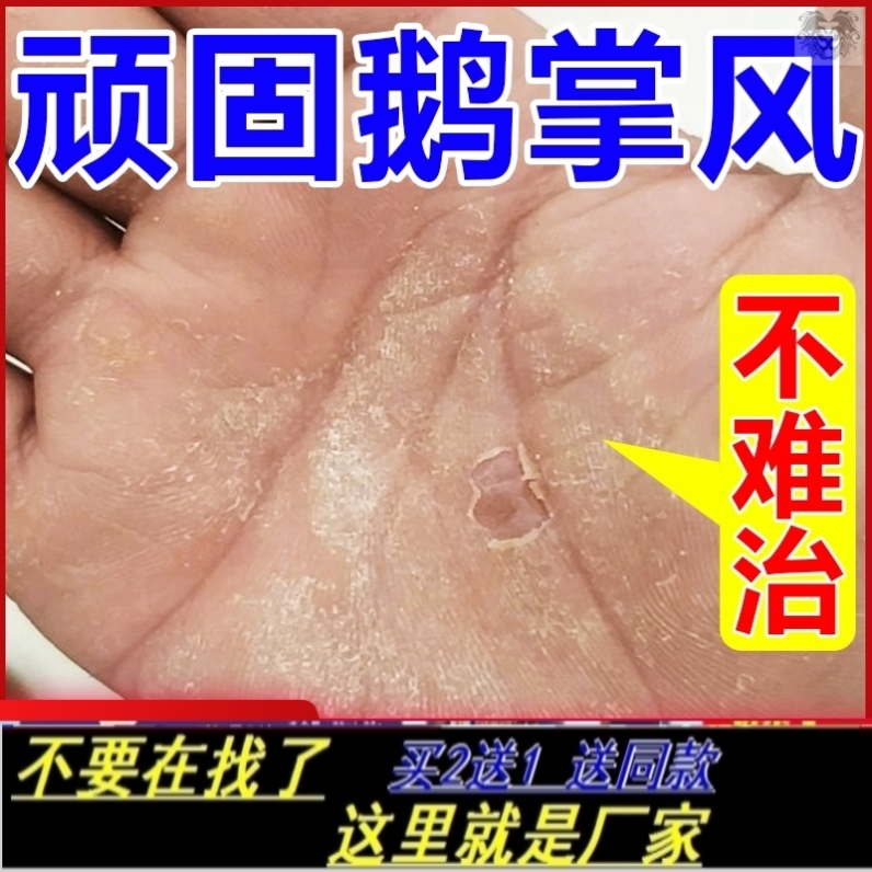 手癣膏真菌感染手部鹅掌风手足癣干裂脱皮瘙痒粗糙汗疱疹专用药膏