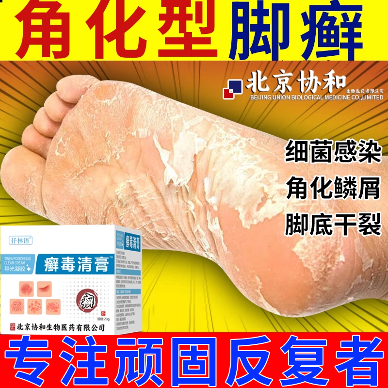 角化型湿疹足癣脚癣一次净脚裂后跟干裂修复霜脱皮真菌感染kj