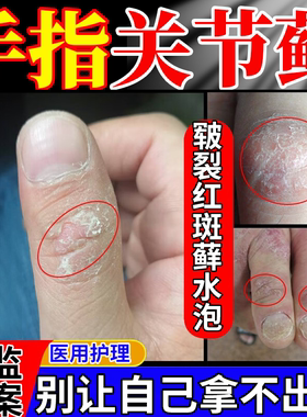 手指关节癣手癣膏脱皮干裂真菌感染一次净手藓湿疹去止痒根脚WYD