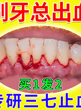 牙龈出血专用牙膏治牙周炎口腔牙龈萎缩止血抗敏美白去黄去口臭SC